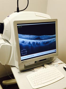 optische Kohärenztomographie